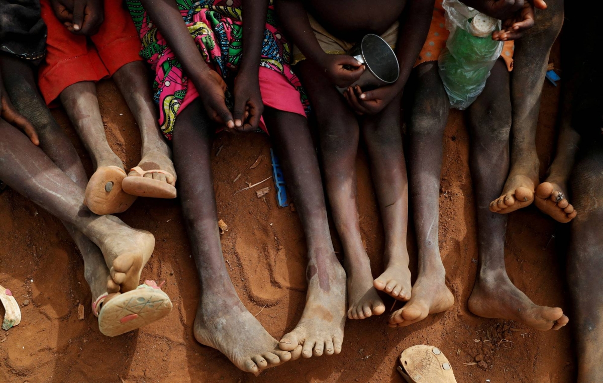 Millions of malnourished children face lifelong health woes